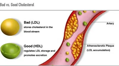 What Happens if Bad Cholesterol is High in our Body?